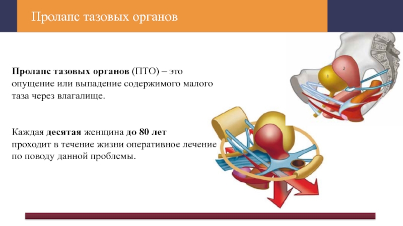 Пролапс тазовых органов презентация