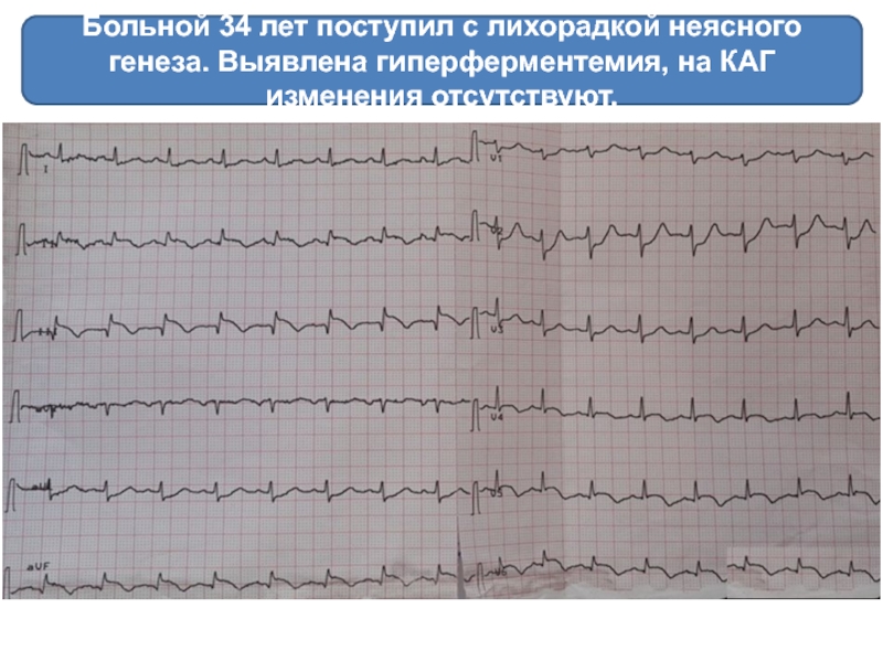 Элевация сегмента st что это