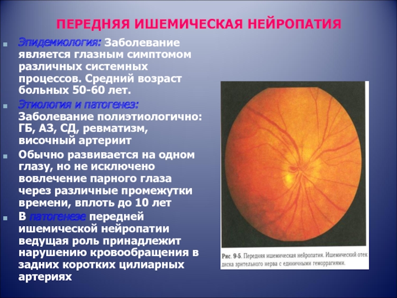 Нейропатия глаза. Передняя ишемическая нейропатия зрительного. Передней ишемической нейропатии зрительного нерва. Оптикопатия зрительного нерва. Передняя ишемическая оптиконейропатия зрительный нерв.
