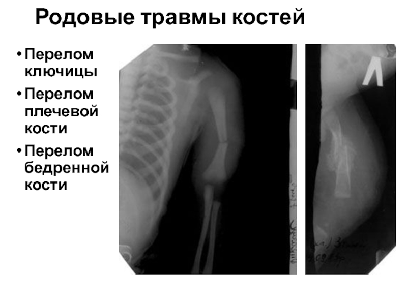 Родовая травма презентация