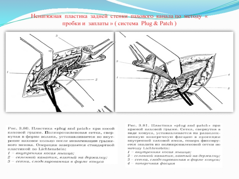 Пластика задней. Методы пластики задней стенки пахового канала. Способы укрепления задней стенки пахового канала. Методы операций пластика передней и задней стенок пахового канала. Метод пластики задней стенки пахового канала (по автору).