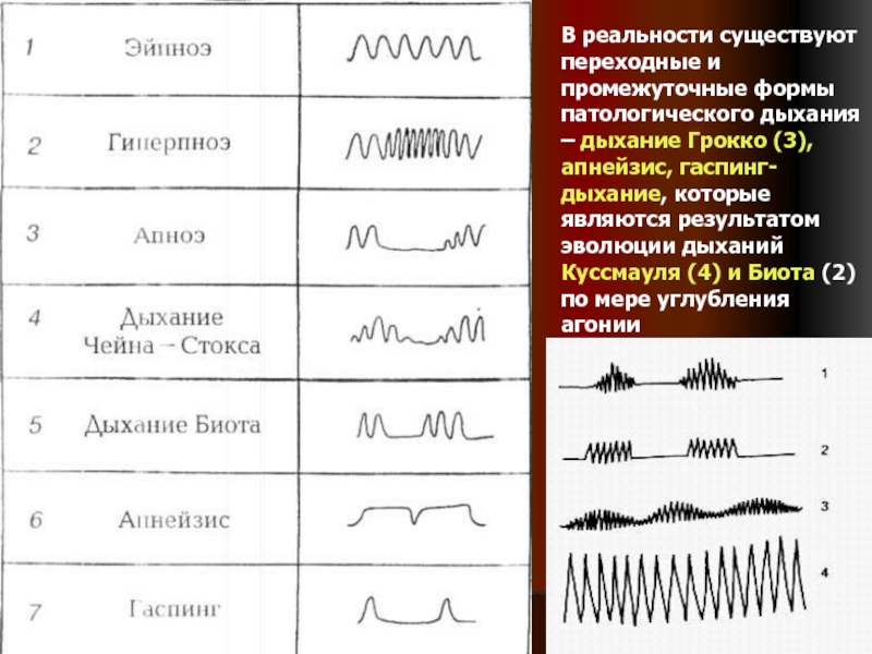 Апнейстическое дыхание рисунок