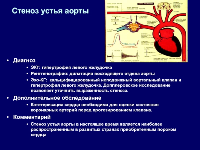 Склероз аорты сердца что