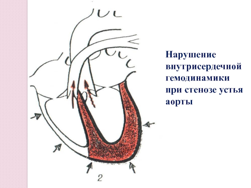 Стеноз устья аорты гемодинамика схема