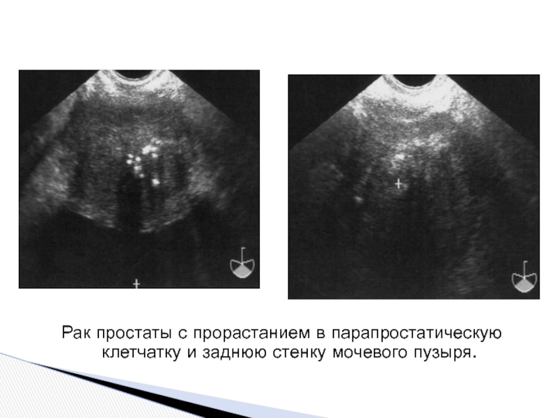 Как выглядит рак предстательной железы на узи фото