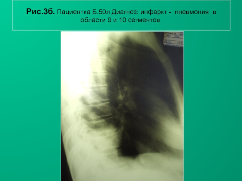Н.С. Воротынцева, С.С. Гольев РентгенопульмонологияРис.3б. Пациентка Б.50л Диагноз: инфаркт - пневмония в области 9 и 10 сегментов.