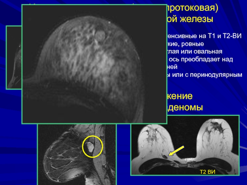 Лучевая диагностика заболеваний молочных желез презентация