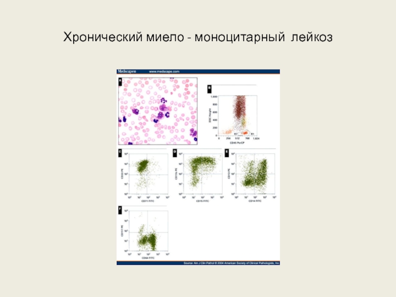 Лейкозы пропедевтика презентация