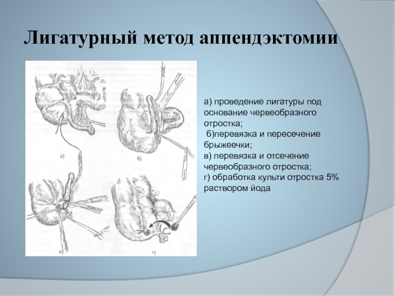 Особенности клинической картины острого аппендицита при тазовом расположении червеобразного отростка