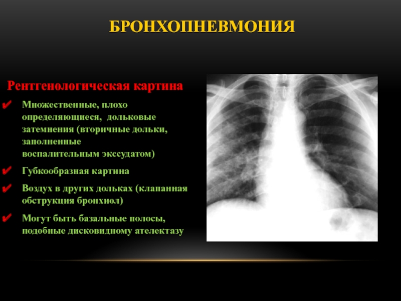 Рентгенологическая картина пневмонии у детей