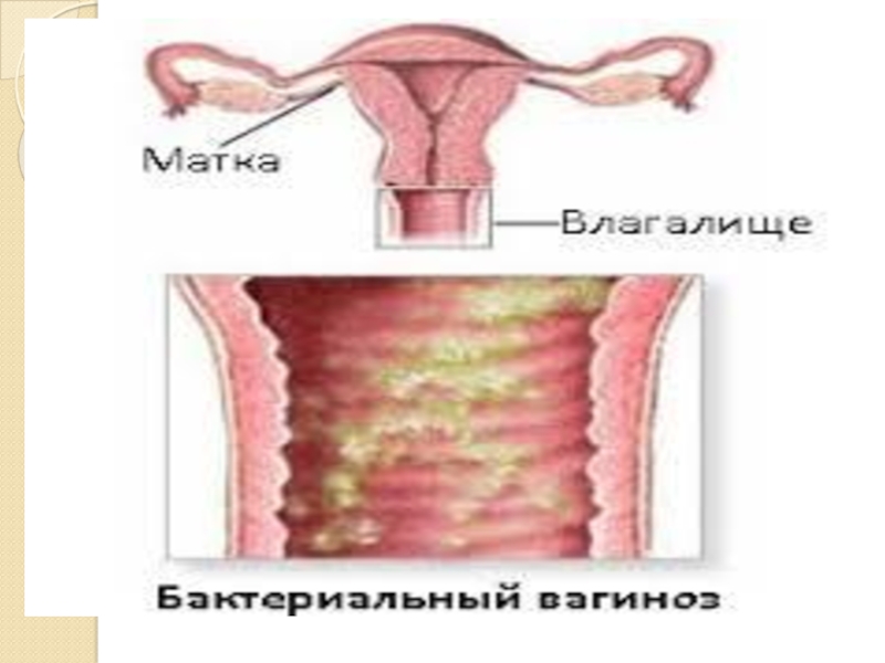 Бактериальный вагиноз. Бактериальный вагиноз патогенез. Бактериальный вагиноз как выглядит.