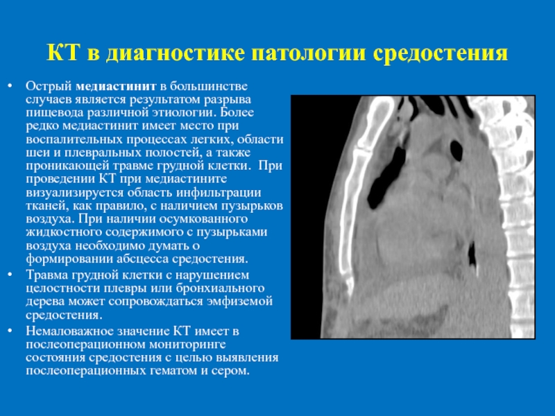 Медиастинит кт картина