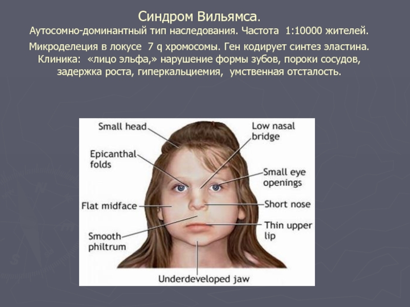 Синдром специфической эльфоподобной внешности фото