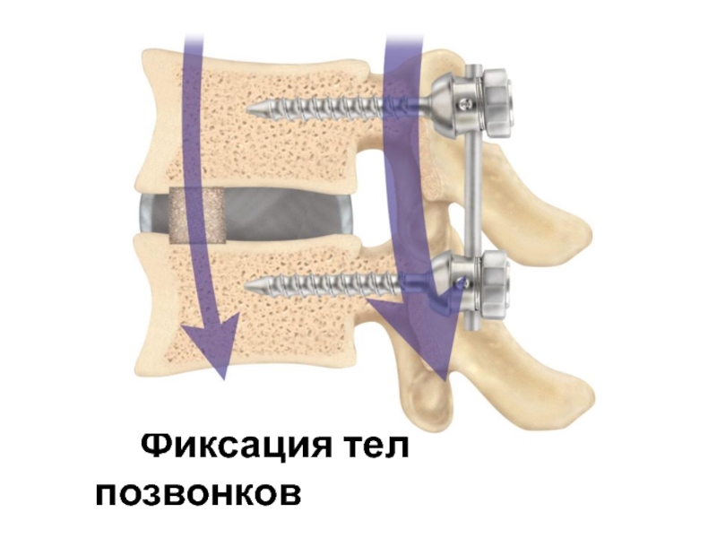 Фиксация позвоночника