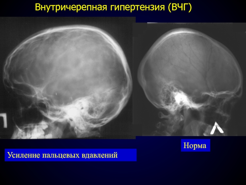 Рисунок пальцевых вдавлений и сосудистых борозд усилен