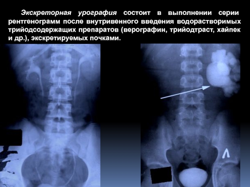 Экскреторная урография. Внутривенная урография нефросклероз. Экскреторная урография почек фазы. Внутривенная экскреторная урография. Нормальная экскреторная урография.