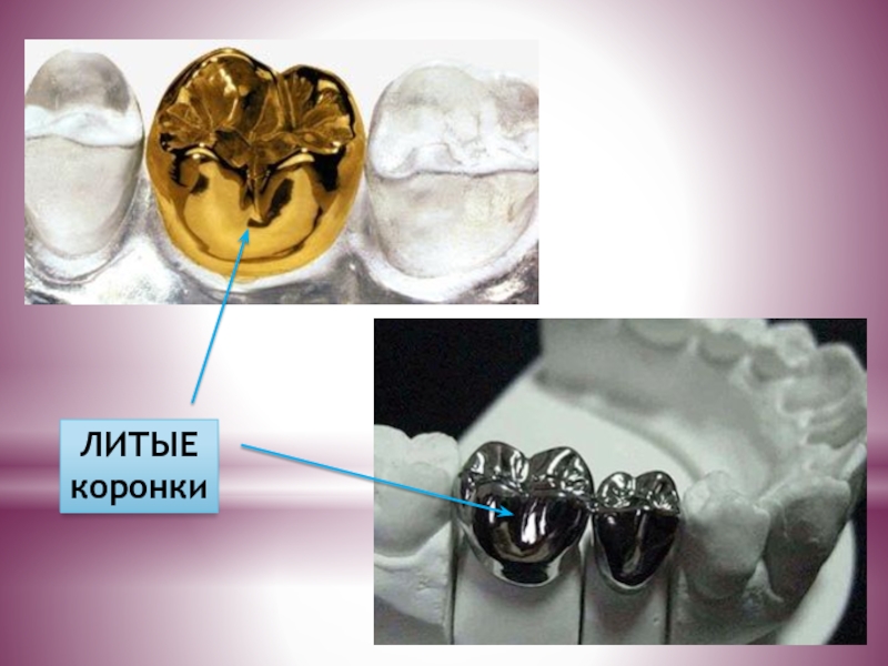 Металлические коронки презентация