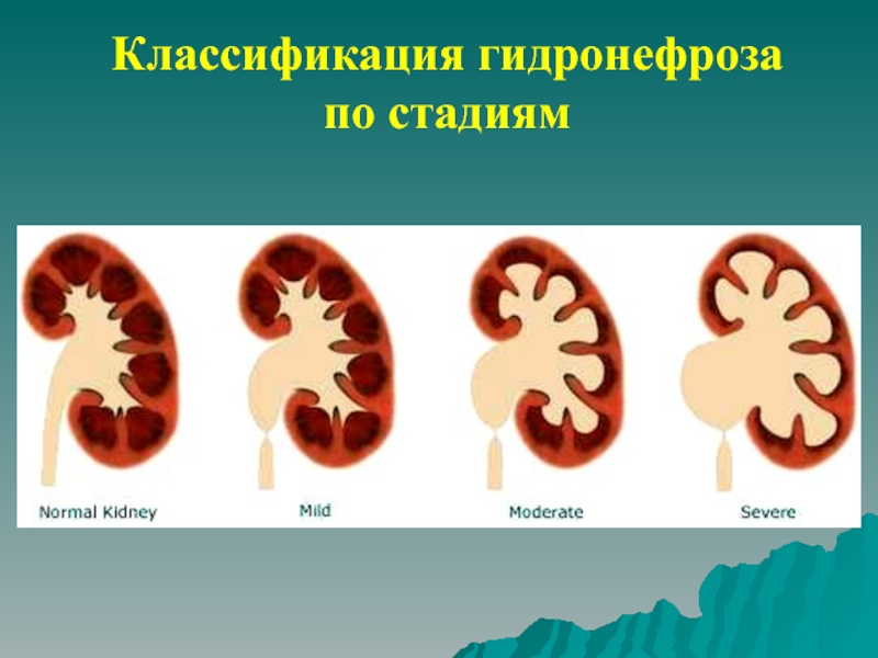 Гидронефроз у детей презентация