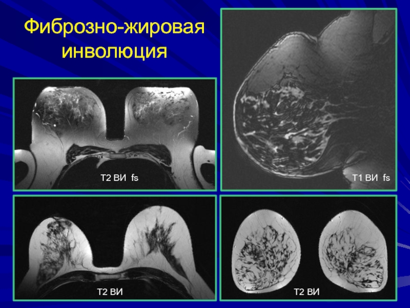 Жировая инволюция молочных