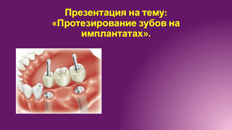 Протезирование зубов на имплантатах