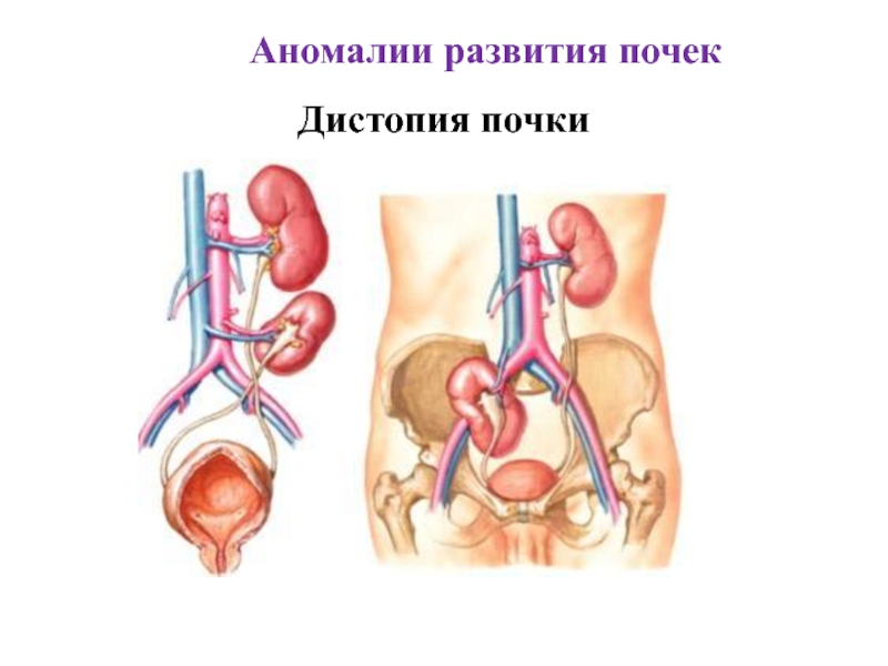 Аномалии мочеполовой системы презентация