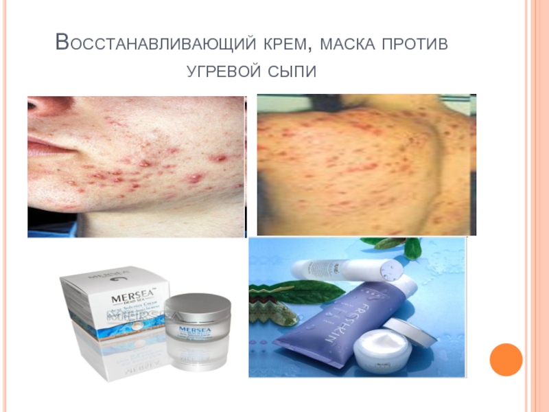 Восстанавливающий крем, маска против угревой сыпи http://www.moi-roditeli.ru/pupil/bahaviour-development/skin-care-acne.html