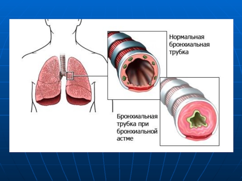 Бронхиальная астма картина