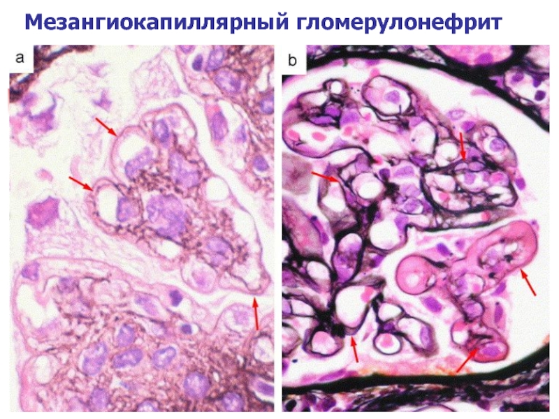 Острый гломерулонефрит микроскопическая картина