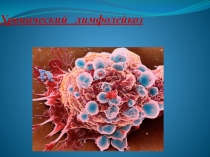 Хронический лимфолейкоз