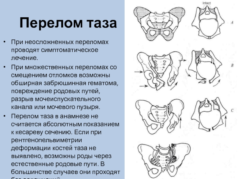 Для перелома характерно тест. Классификация переломов костей таза.