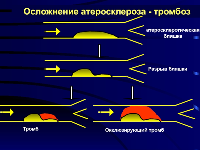 Осложнения атеросклероза тест