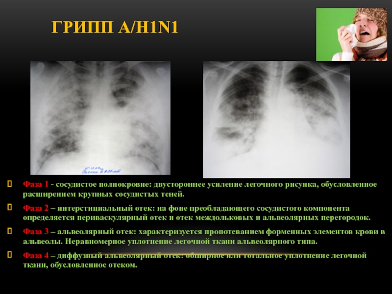 После пневмонии легочный рисунок усилен