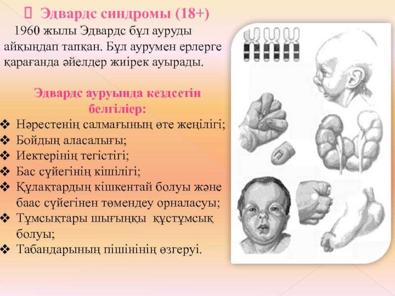 Синдром картины. Синдром Эдвардса фенотип. Синдром Эдвардса фенотипические проявления. Синдром Эдвардса клинические проявления.