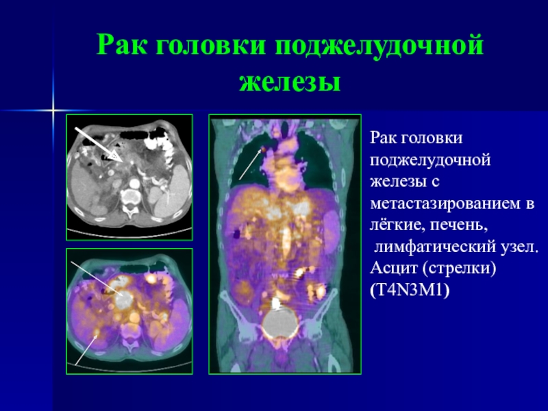 Рак головки. Опухоль головки поджелудочной. Лучевая диагностика поджелудочной железы. Онкология головки поджелудочной железы. Опухоли поджелудочной железы презентация.