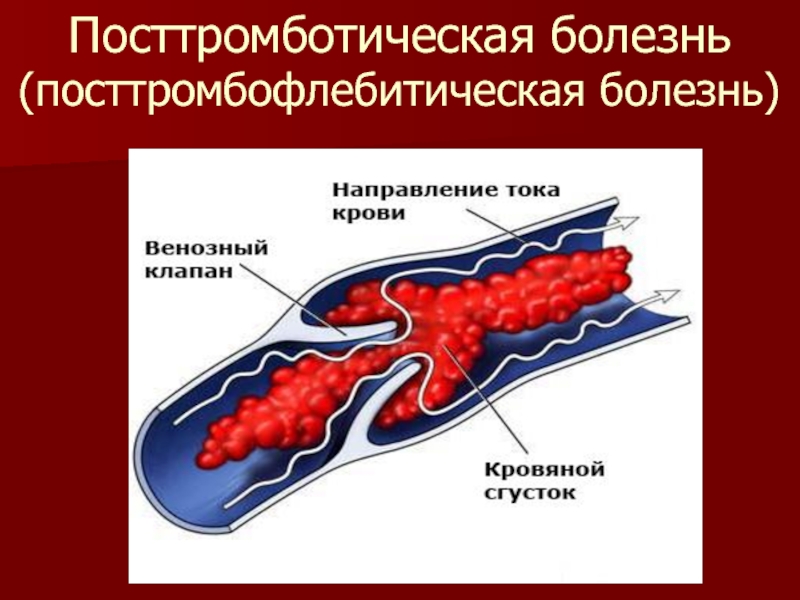 Посттромбофлебитический синдром презентация