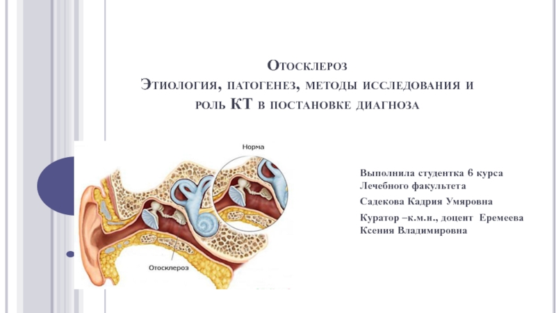 Презентация Отосклероз Этиология, патогенез, методы исследования и роль КТ в постановке