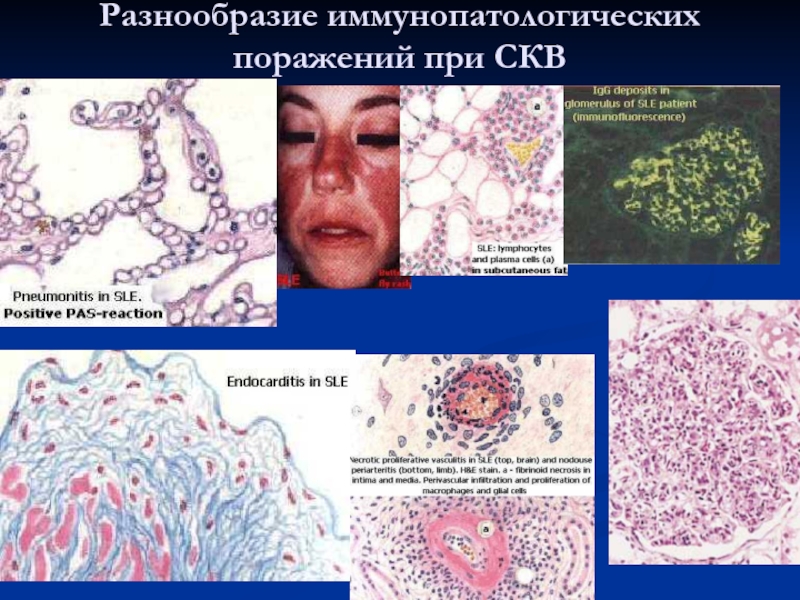Пораженная ткань. Иммунопатологические состояния патофизиология. Иммунопатологические состояния обусловленные развитием опухолей. Иммунопатологическая реакция системной красной волчанки. Иммунопатология патанатомия презентация.