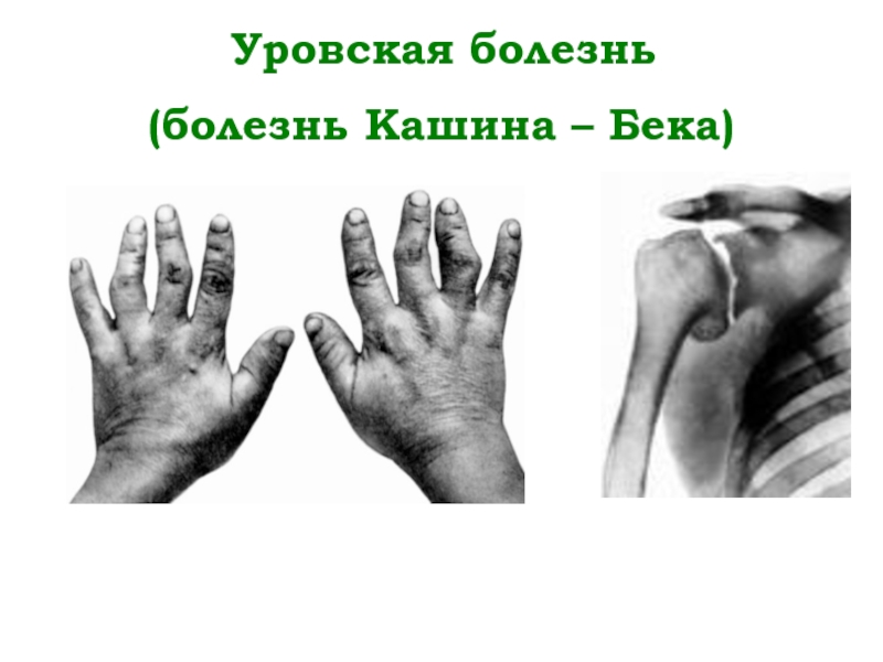 Болезнь заболевание. Уровская болезнь или болезнь Кашина-Бека. Кашина — Бека (Уровская болезнь) люди. Уровско-Бековская болезнь.