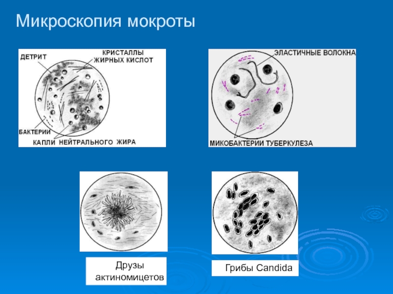 Друзы актиномицетовГрибы CandidaМикроскопия мокроты