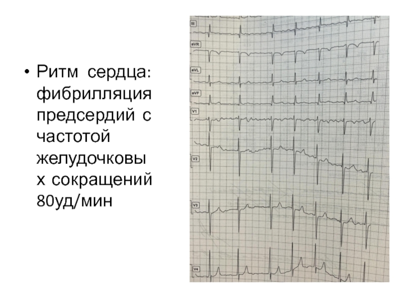 Ритм сердца: фибрилляция предсердий с частотой желудочковых сокращений 80уд/мин