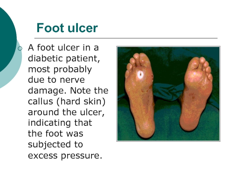 Foot ulcerA foot ulcer in a diabetic patient, most probably due to nerve damage. Note the callus