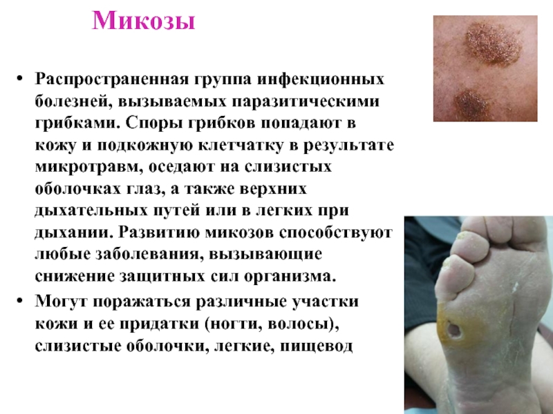 МикозыРаспространенная группа инфекционных болезней, вызываемых паразитическими грибками. Споры грибков попадают в кожу и подкожную клетчатку в