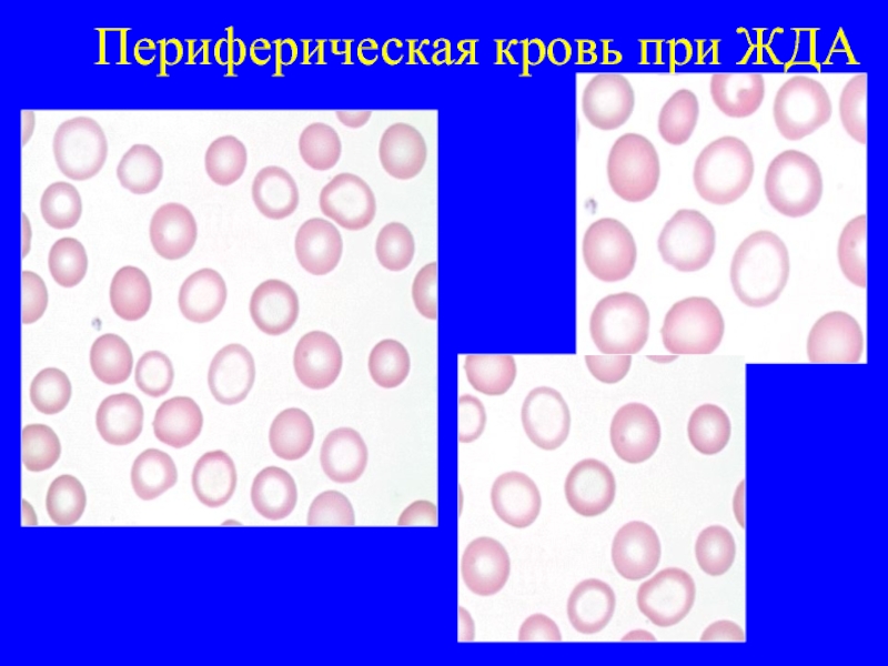 Для железодефицитной анемии характерна такая картина периферической крови