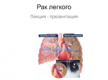 Рак легкого