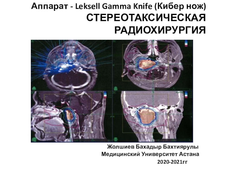 Аппарат - Leksell Gamma Knife ( Кибер нож) СТЕРЕОТАКСИЧЕСКАЯ РАДИОХИРУРГИЯ