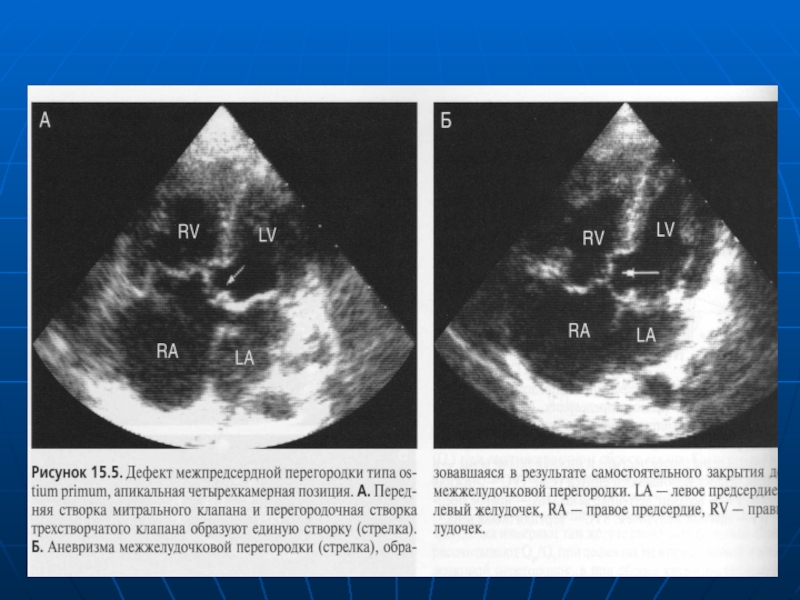 Аневризма мпп. Дефект межпредсердной перегородки на ЭХОКГ. Створки трикуспидального клапана на УЗИ. Дефект межжелудочковой перегородки ЭХОКГ. Дефект межжелудочковой перегородки УЗИ.