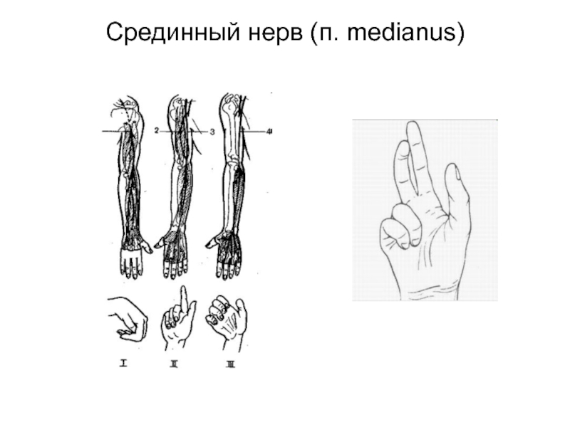 Срединный нерв. Срединный нерв (n. medianus) иннервирует:. Проекция срединного нерва на предплечье. Проекция локтевого нерва на предплечье.