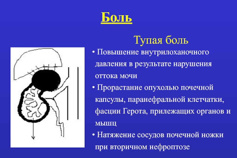 Опухоли почек презентация