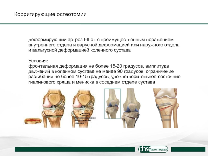 После остеотомии коленного сустава. Корригирующая остеотомия большеберцовой кости. Корригирующая остеотомия таза. Корригирующая остеотомия коленного сустава. Корригирующая остеотомия голени.