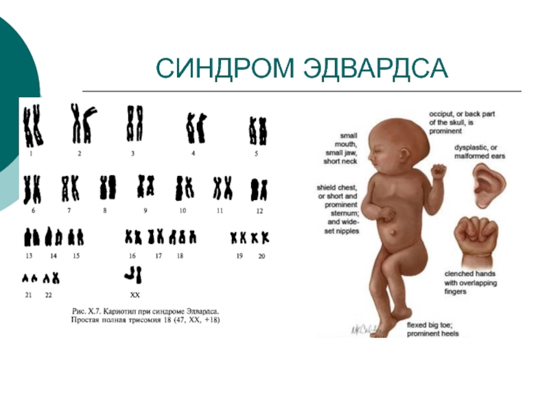 Синдром эдвардса фото узи